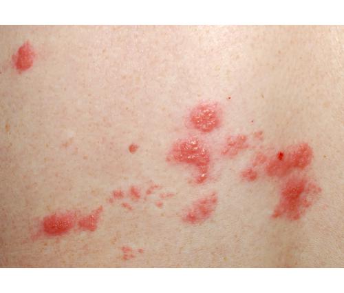 itchy spot skin cancer