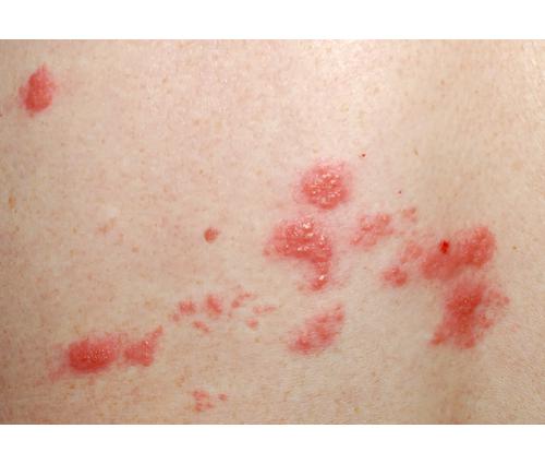 All 28+ Stock Photos are pimples a sign of breast cancer Sharp All 28+ Stock Photos are pimples a sign of breast cancer Sharp