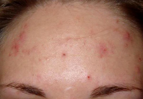 On Forehead