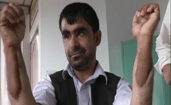 afghan-soldier-hand-transplant_650x400_71431838518