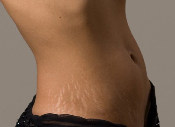 Stretch marks