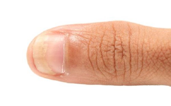 Nail infections